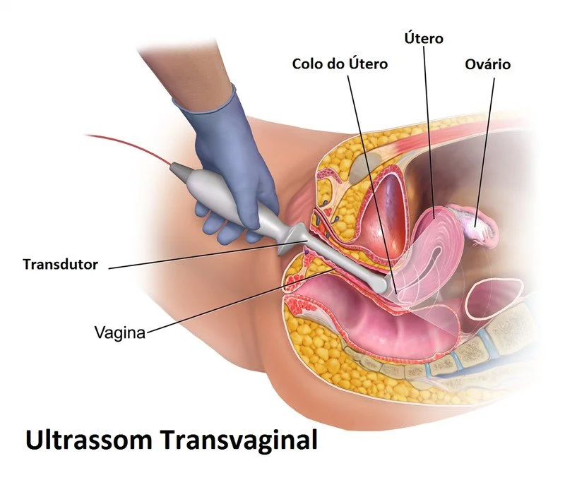 Ultrassonografia transvaginal