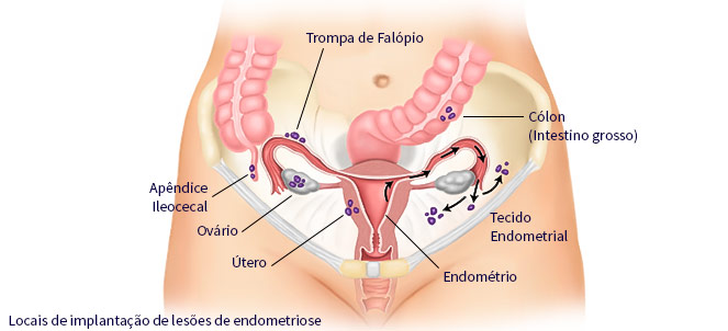 Locais na pelve acometidos pela endometriose
