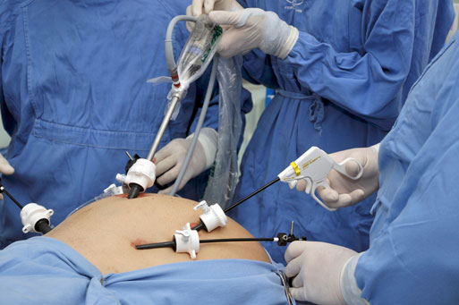 Cirurgia laparoscopia para endometriose