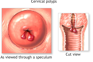 Pólipo cervical 
