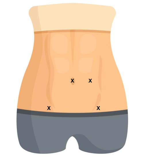 Incisões Laparoscopia 