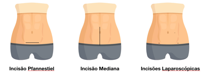 Incisões 